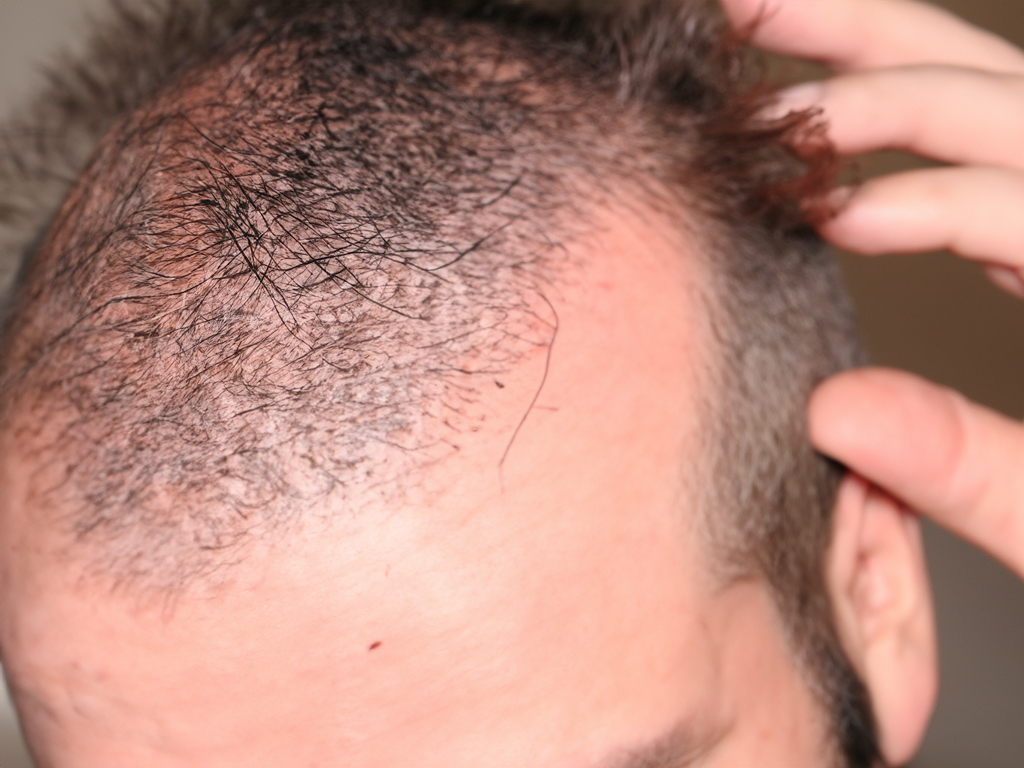 Rosmarin gegen Haarausfall: Wundermittel oder Mythos?